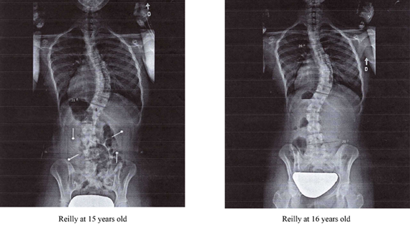 Scoliosis treatment results in x-ray