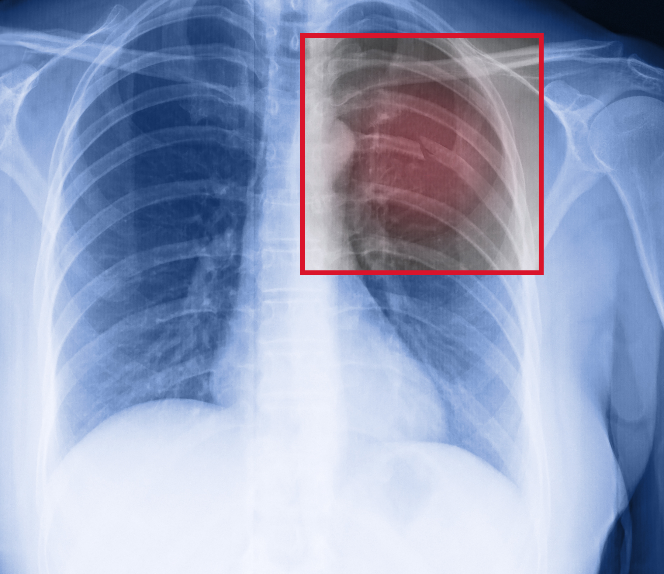 Закрытая травма легкого. Перелом грудной клетки рентген. Перелом ребра снимок рентген. Снимок грудной клетки с переломом ребер.